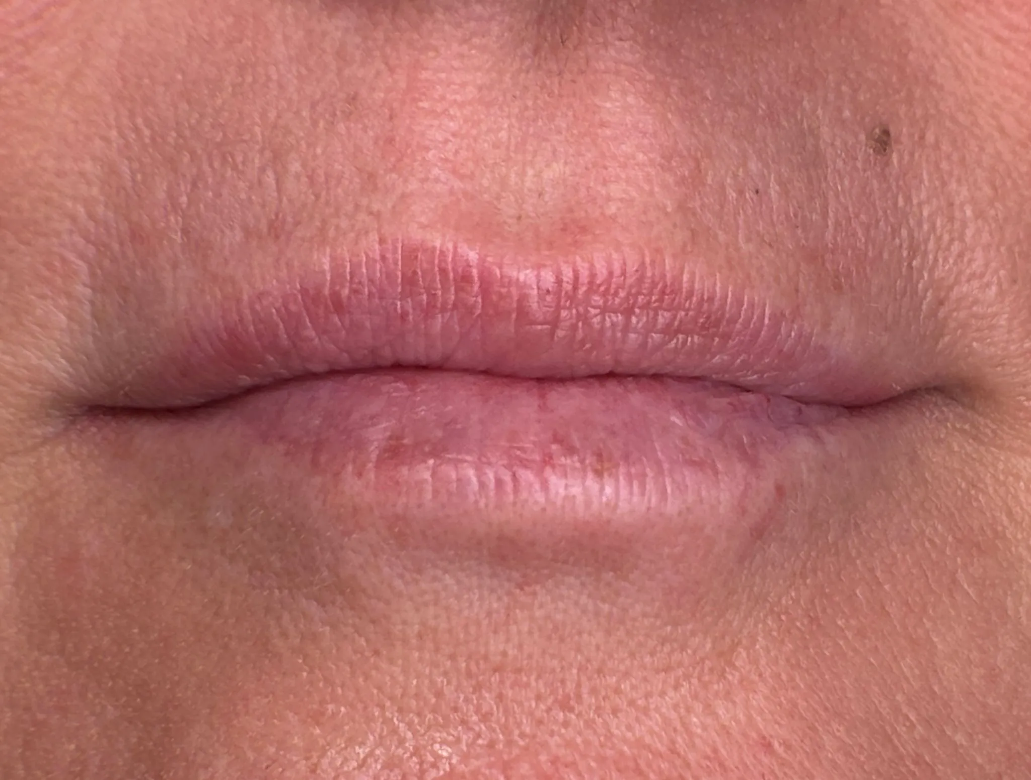 Lips before Lip Blush treatment